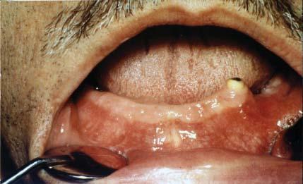 Serbian Dental J, 2006, 53 19 Cilj Imaju i u vidu zna aj zadržanih zuba za funkcionalnu vrednost proteze to je i cilj ovog istraživanja da utvrdi efekte SDP na stanje alveolarne kosti oko zadržanih