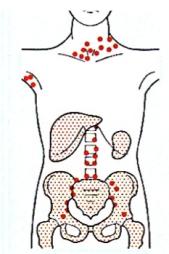 Hodgkin-ov limfom Stadijum I II III IV Šta znači Bolest je zahvatila jedan limfni region Bolest je zahvatila dve ili više limfne regije sa iste strane dijafragme.