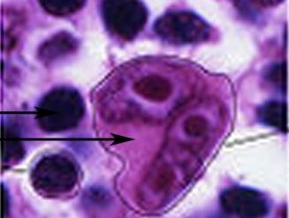 Hodgkin-ov limfom Drugu grupu čine klasični Hodgkin-ovi limfomi, koji obuhvataju 4 podvrste: Limfocitna predominacija Mešovita celularnost Nodularna skleroza Limfocitna deplecija Normalna ćelija