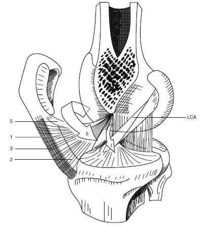 Slika 6. Šematski prikaz sinovijalne ovojnice i infrapatelarnog masnog tkiva sa prikazanim komunikacijama medijalnog i lateralnog kompartimenta.