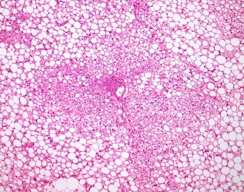 Slika 1: Alkoholni steatohepatitis (preuzeto s http://www.webpathology.com/) (31) 3.