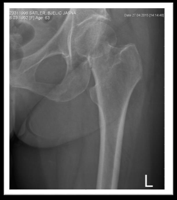 4.3. Dijagnostika Kod kliničke evaluacije važno je da pacijenti s frakturom femura s pomakom ne djeluju kao ambulantni pacijenti, a prisutno je skraćenje noge i vanjska rotacija.