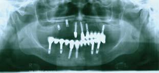SLIKA 1. Ortopantomografski snimak pacijenta kod kojeg je skinut gorwi most s desne strane usled lomqewa implantata. FIGURE 1.