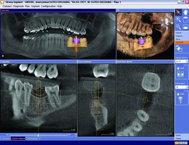 Slika 2. Navigaciona implantologija; Primjer planiranja pozicije implantata u softverskom sistemu Sirone. Preuzeto: (Link 2).