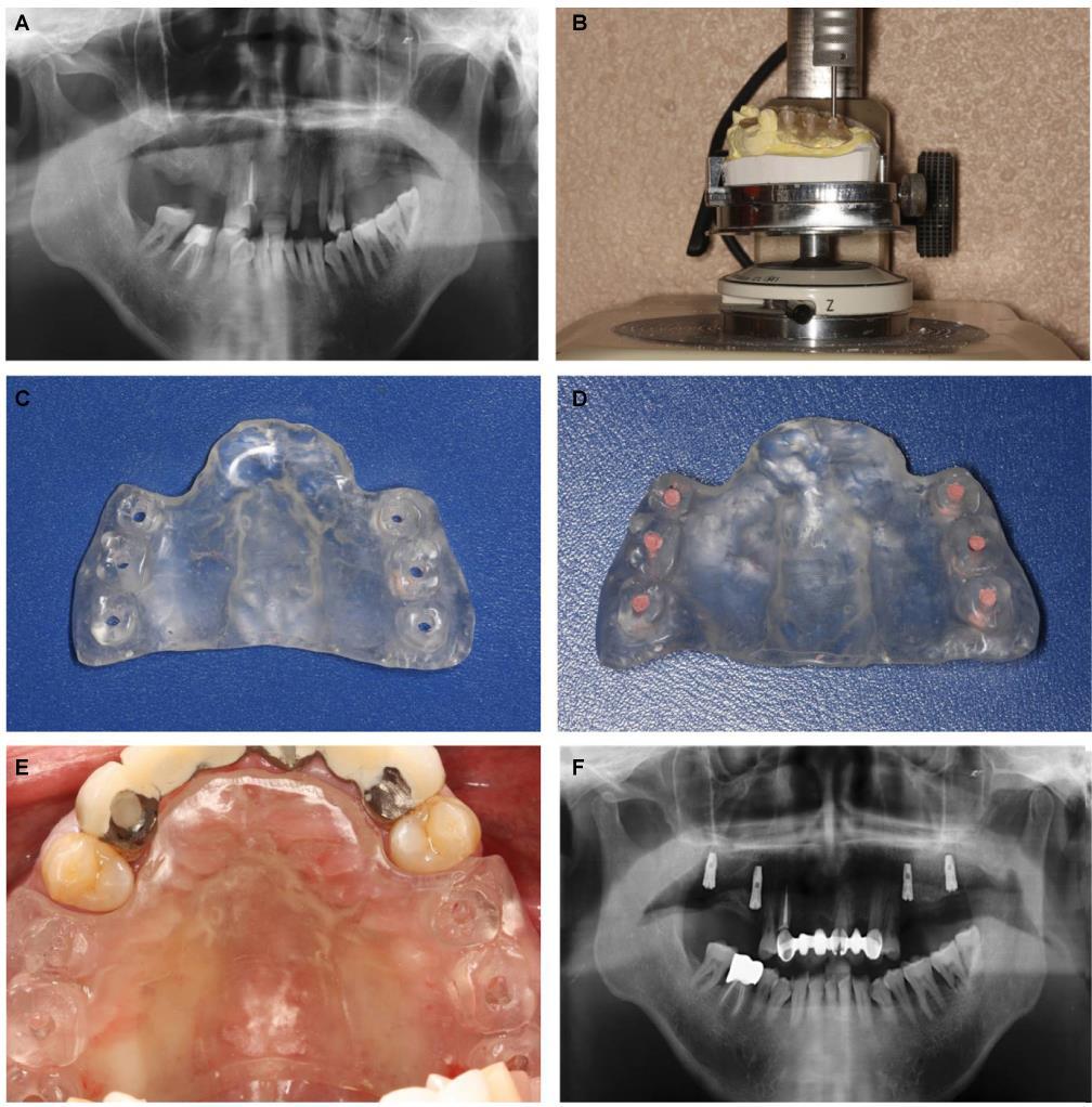 Slika 4. (A) Ortopantomogram. (B) Perforacija stenta na studijskom modelu (?). (C) Izgled hirurškog stenta nakon perforacije.