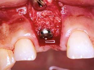 Slika 5.Nadoknada koštanog tkiva oko postavljenog implantata. Preuzeto: (Link 5).