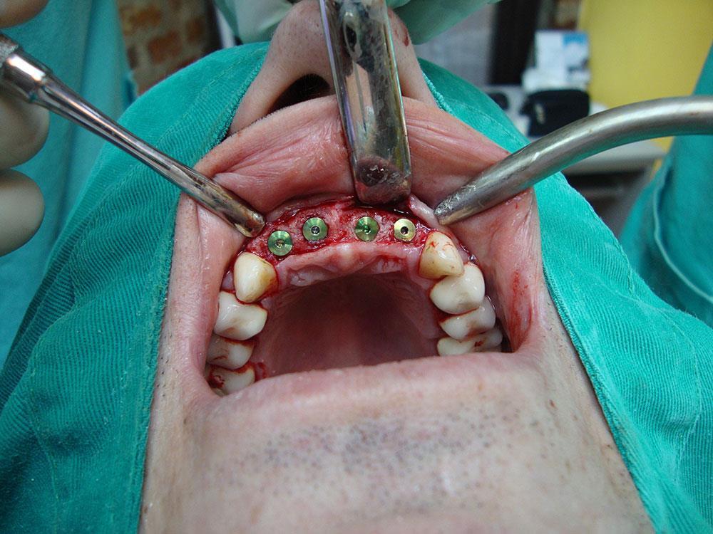 Slika 11. Primjer klasične metode ugradnje dentalnog implantata odizanjem mukoperiostalnog režnja. Preuzeto: (Link 10).
