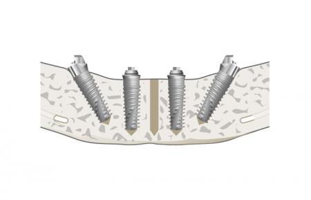 Klasična implantološka terapija zahtijeva tijekom cijeljenja dvofaznu tehniku bez opterećenja.