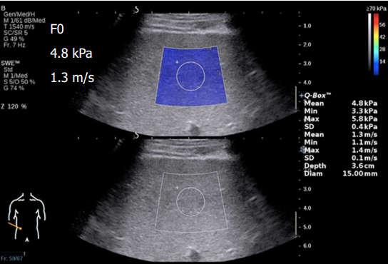 Slika 1. Primjer elastograma jetre. Slika je preuzeta iz internetskog članka (13).