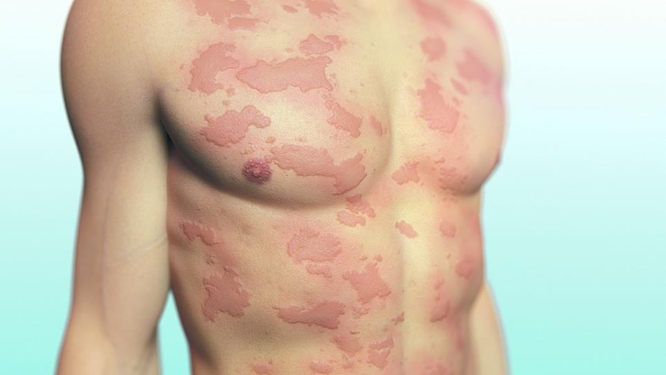 Osnova urtike (uzdignuće kože) je edem, koji je nastao zbog širenja i povećane propusnosti najmanjih krvnih žila (kapilara) u gornjem sloju kože.