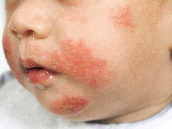 Slika 9. Atopijski dermatitis kod djeteta (http://dijetaplus.com/tn-zasto-se-javlja-atopijski-dermatitis-kod-beba-i-kako-se-leci/) Slika 10.