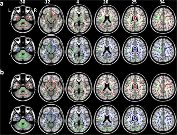 Slika 13. Difuzni tenzorski MR imidžing. Rezultati Tract-Based Spatial Statistics (TBSS): (A) ABam u poređenju sa zdravim kontrolama i (B) FTDbv u poređenju sa zdravim kontrolama.