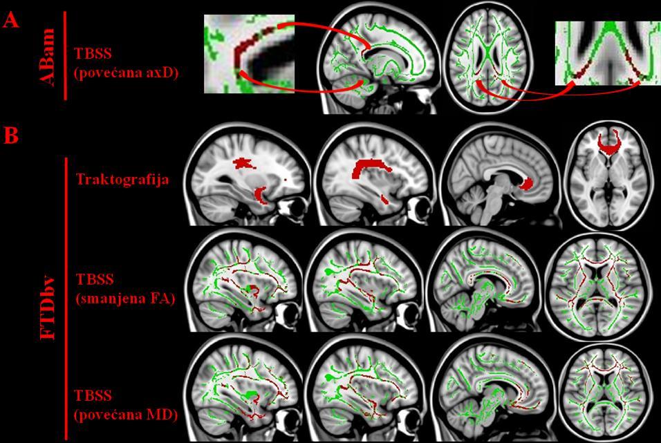 Slika 14. Difuzni tenzorski MR imidžing. A) Rezultati Tract-Based Spatial Statistics (TBSS) u ABam u poređenju sa slučajevima FTDbv. Značajni vokseli su uvećani radi boljeg viđenja.