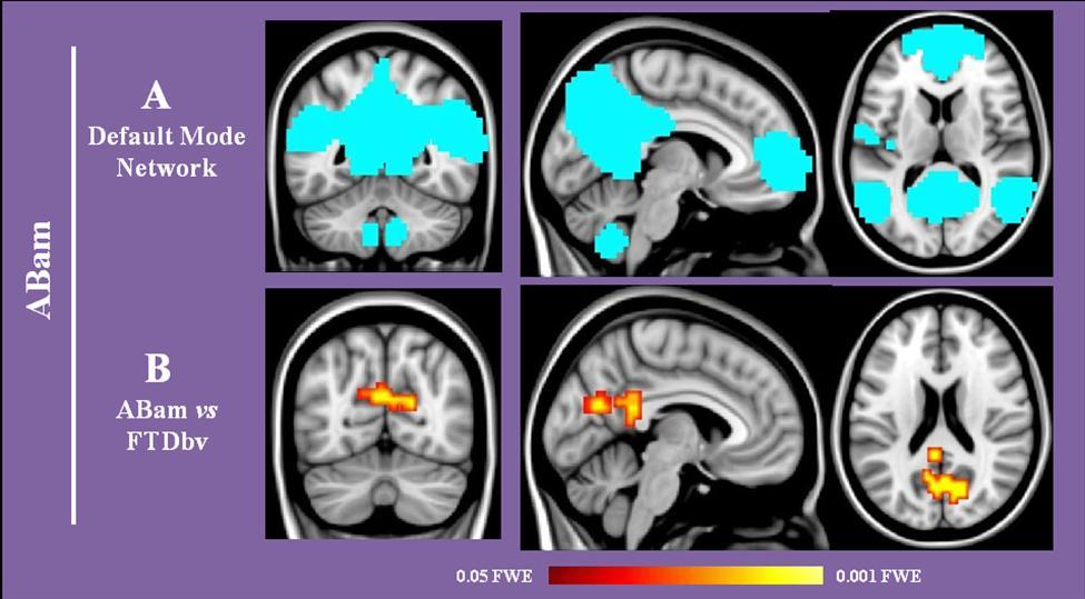 Slika 15. Rezultati Resting state funkcionalne povezanosti.