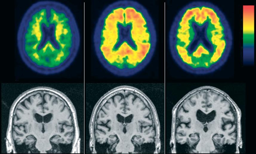al. 2007). Suprotno ovome, nalaz atrofije na MR mozga korelira sa kognitivnim simptomima do krajnjih stadijuma AB (Vemuri et al. 2009). A B C Slika 3.