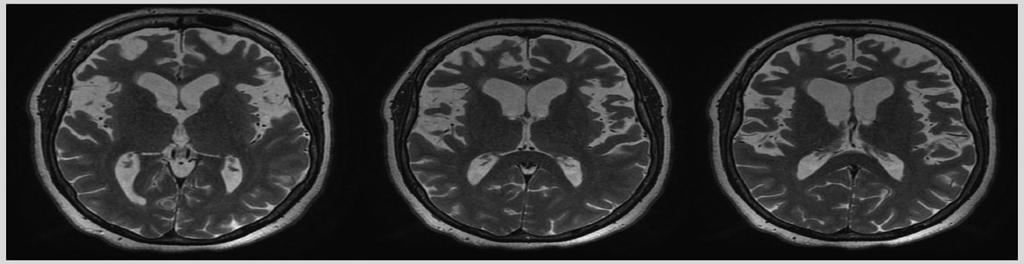 nivou frontalno-zavisnih memorijskih funkcija (kakvo je i prizivanje upamćenog materijala) pre nego pravim amnestičkim (hipokampalnim) poremećajima (Hornberger et al. 2012, Glosser G et al. 2002).