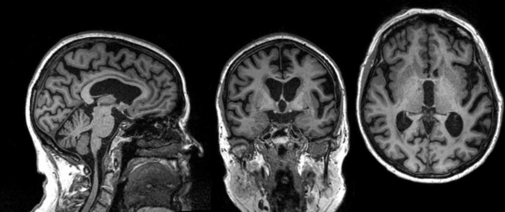 se obično uočavaju u svakodnevnom govoru uz izostavljanje veznika, nastavaka imenica i glagola- telegrafski govor (Woollacott et al. 2016).