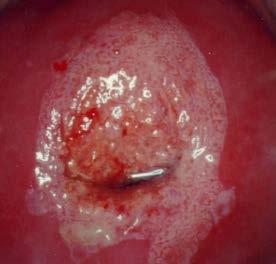 Colposcopy and Treatment of Cervical Intraepithelial