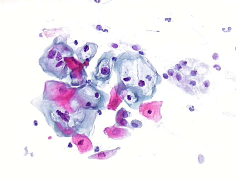 Koilociti predstavljaju morfološku manifestaciju produktivne HPV infekcije Deskvamirane ćelije stratuma korneuma predstavljaju transportere HPV za dalju infekciju.