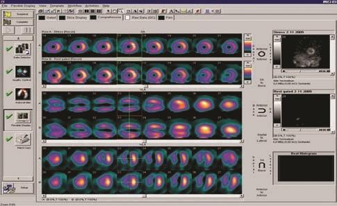 MATERIALS AND METHODS Study population A retrospective analysis was carried out on 70 patients (51 male and 19 female) who undervent rest-stress myocardial perfusion scintigraphy between 2013 and