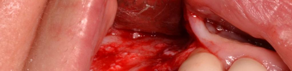 Slika 1.5 Dvofazni sinus lift-ugradnja implantata nakon zarastanja grafta (desno) Slika 1.