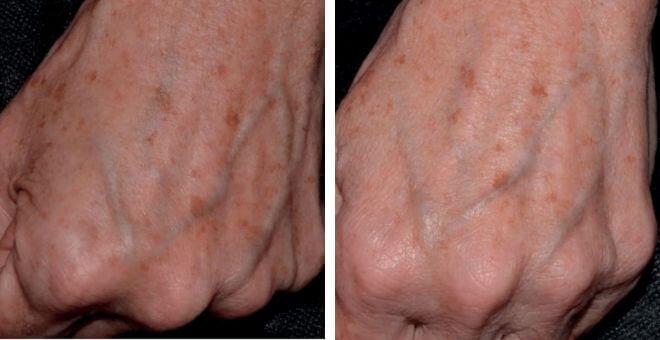 Ruke prije primjene Melascreen kreme (lijevo) i nakon 2 mjeseca korištenja (desno) Ducray Melascreen liniju potražite u ljekarnama.