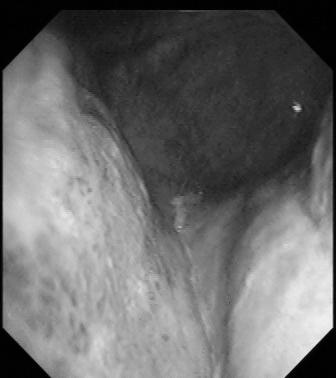 Br. 1 Uloga endoskopske ultrasonograf. u inicijalnom odredjiva- 87 nju i pra}enju bolesnika sa MALT limfomom SLIKA 3.
