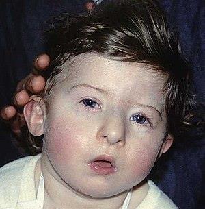 Slika 2. Fenotip djeteta s DiGeorgeovim sindromom (preuzeto sa https://en.wikipedia.