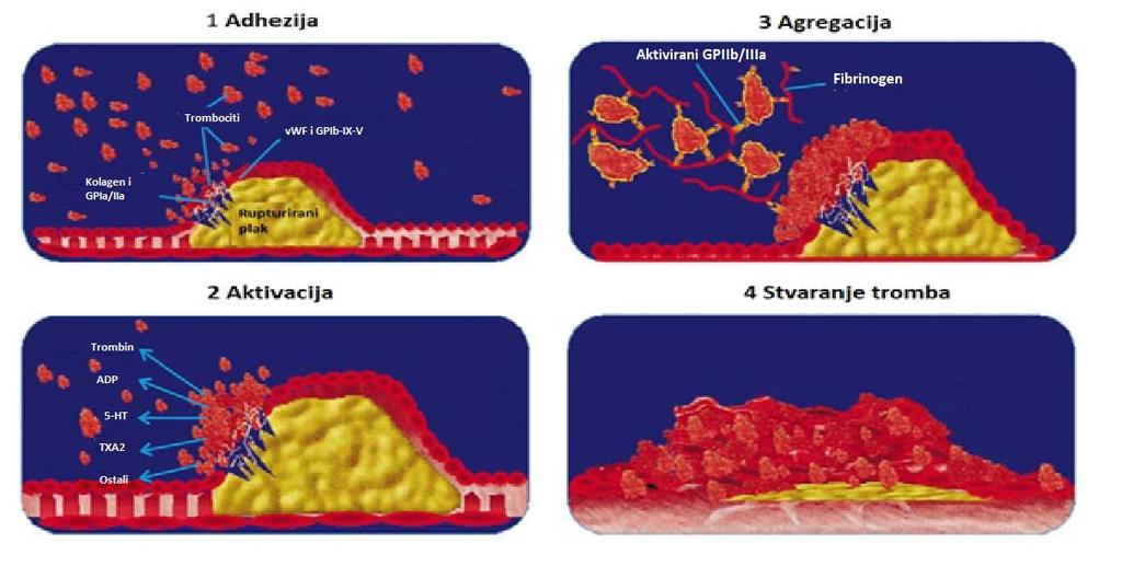 Slika 7. Uloga trombocita u patogenezi arterijske tromboze nakon rupture aterosklerotskog plaka.