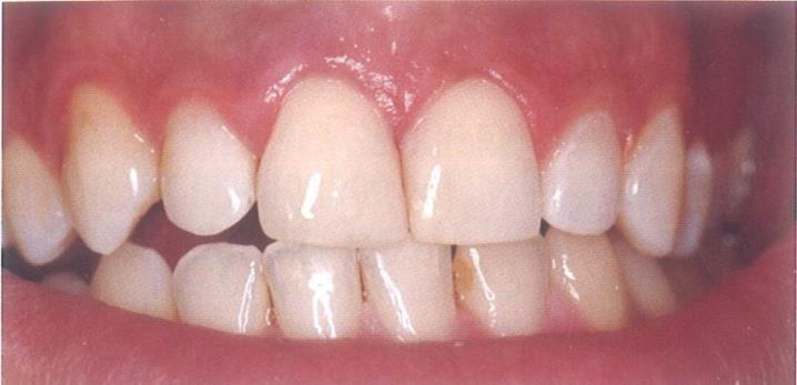 Indikacije za izradu protetskih nadomjestaka ovise o vrsti estetskog odstupanja, opsegu oštećenja pojedinaĉnog zuba ili skupine zubi, starosti pacijenta i njegovim financijskim mogućnostima.
