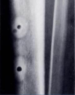 Slika 1. Radiološka slika prstenastih sekvestara kao posljedica termičke nekroze [2]
