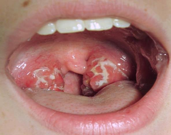 Slika 3. Lakunarni tonzilofaringitis, preuzeto sa: https://acikgunluk.