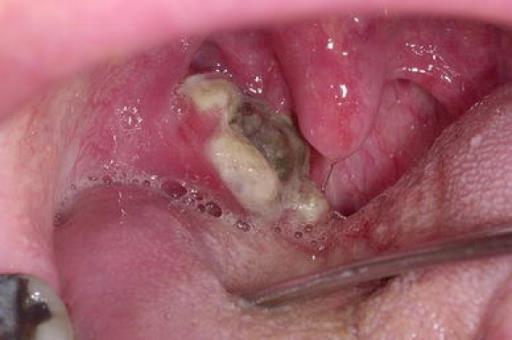 Slika 5. Nekrotizirajući tonzilofaringitis preuzeto sa: http://www.ralf-heiser.info/newgufwd-ulcer-on-tonsil-treatment.