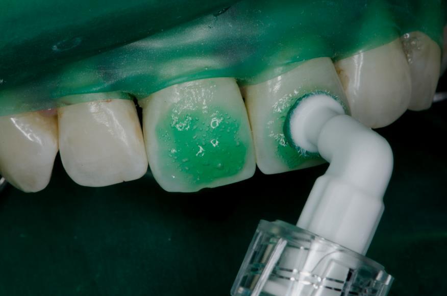 Slika 7. Aplikacija 15% HCl na vestibularne površine zuba. Preuzeto s dopuštenjem autora: izv. prof. dr. sc. Katica Prskalo, dr. med. dent.