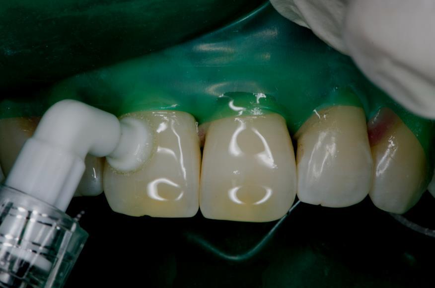 Nakon provedenog predtretmanskog postupka, sljedeći korak je aplikacija niskoviskozne smole na površinu zuba (Slika 9.).