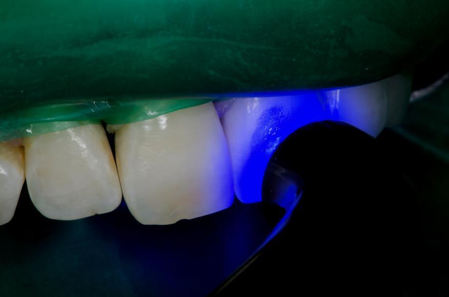mjesto povećanog nakupljanja zubnog plaka i povećavati rizik nastanka zubnog karijesa. Slika 10.