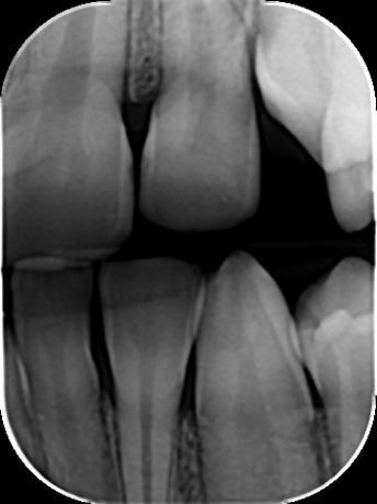 Stoga se naglasak stavlja na ranu dijagnostiku karijesa, osobito onoga na aproksimalnim plohama zuba (Slika 1.).