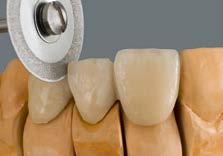 Dijamantnim diskom odvojiti interdentalne prostore posle prvog pečenja dentina.