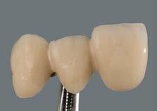 pečenje dentina DENTINE masom se prvo popunjavaju interdentalni prostori.