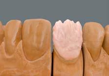 Napomena: Za kompenzaciju senovitih zona, podesno je koristiti dentin sledećeg stepena svetline, odnosno DENTINE masu većeg intenziteta naročito na tankim mestima.