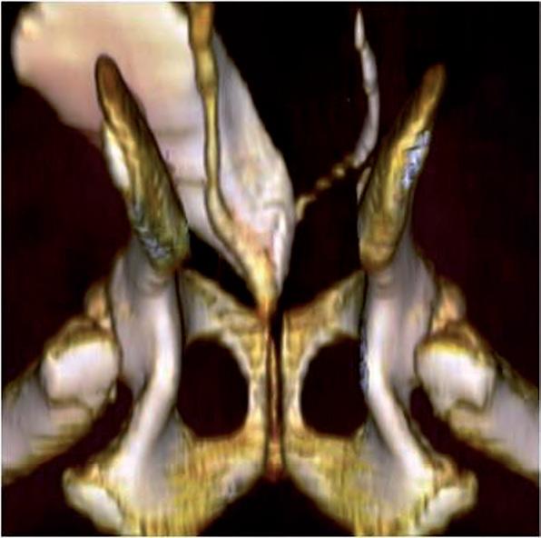 CT snimanje omogućuje da se točno utvrdi priroda poremećaja, pozicija uretera (intra ili ekstramuralno) 