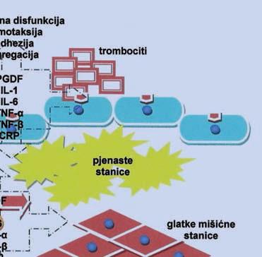 fagocitiranjem oksidiranog LDL- -a; istodobno se zbivaju proliferacija i migracija glatkih mišićnih stanica u subendotelni prostor pri čemu one fagocitiraju oksidirani LDL.