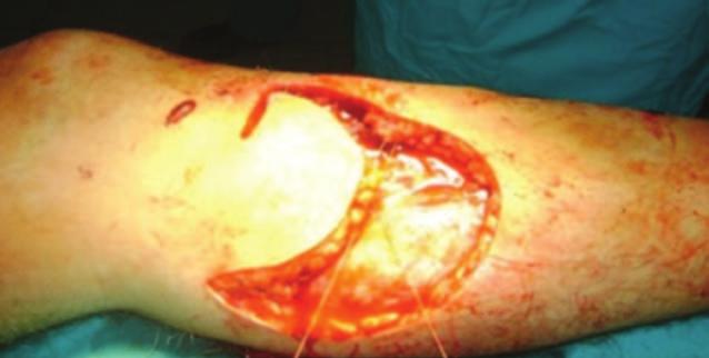 c) Sanacija mekotkivnog pokrova nakon rekonstrukcije kožnom režnjem i slobodnim autotransplantatom nepotpune debljine kože.