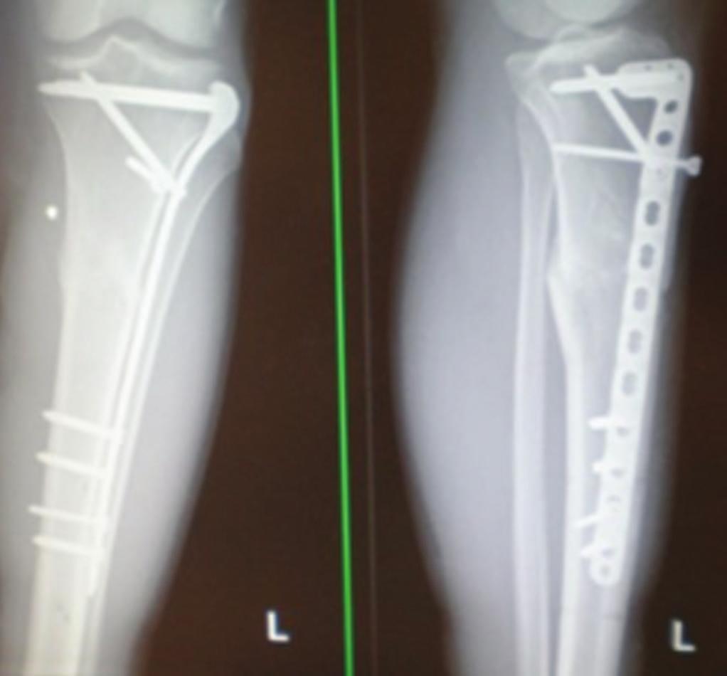 Figure 10 Open mataphyseal tibial fracture. Two stage procedure in the same patient.