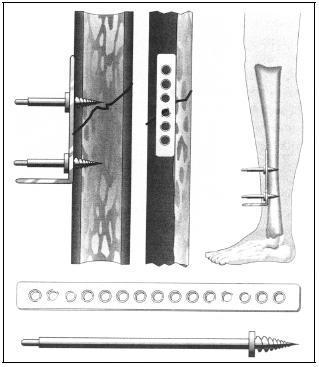 3.2. Osteosinteza pločicom Korištenje pločica kao metode osteosinteze prvi put se spominje 1886. godine u izvještaju Carla Hansmanna Nova metoda za fiksaciju fragmenata složenih prijeloma [12].