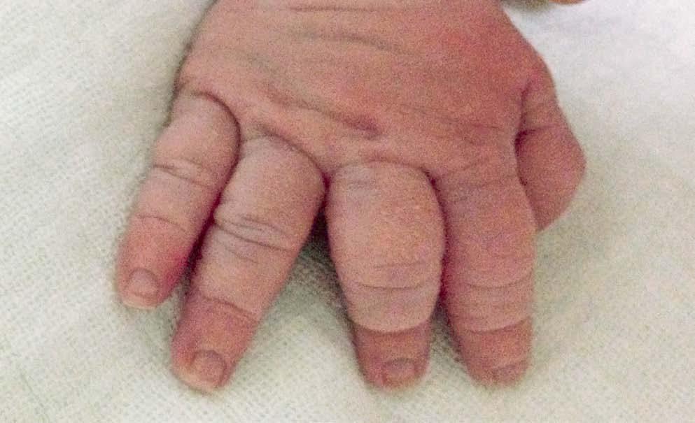 Rendgenska slika novorođenčeta s tanatoforičnom displazijom tipa I pokazuje homogena zasjenjenja u oba plućna krila bez ventilacije plućnog parenhima Figure 3. Newborn with achondroplasia.