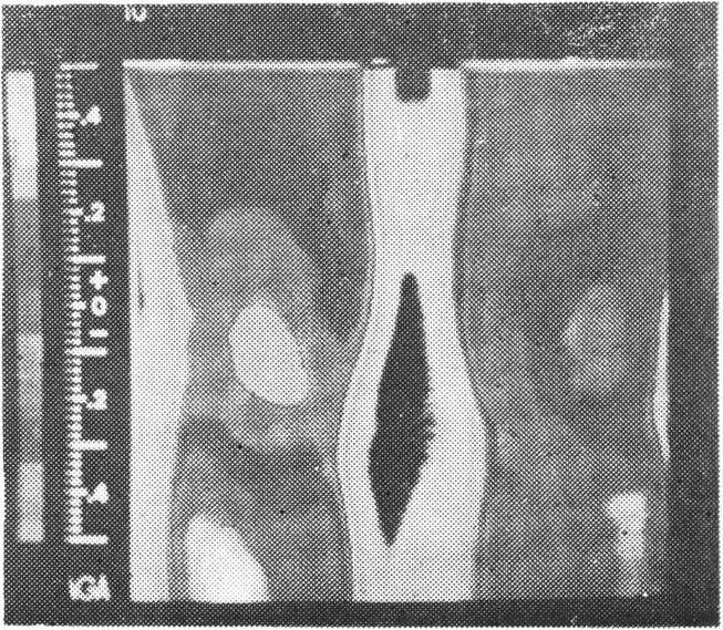 17*-1'-21 - Naše iskustvo po kazuje da je termogram oboljelih s hondromalacijom često impresivan i karakteriziran pojavom izo termi viših vrijednosti u predjelu prepatelarne zo ne,