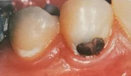 vanjskih slojeva cakline. Dva tjedna nakon neometane akumulacije plaka, promjene na površini zuba postaju vidljive golim okom te je površina zuba mutno bijela i bez sjaja.