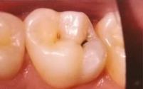 Uzroci su nedovoljna široka rubna pukotina, nepolirani zubni ispuni, uraštavanje rubnih caklinskih prizma, lom ispuna ili zuba. 3. Zaustavljeni karijes.