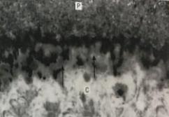 stadiju razvoja karijesa površine korijena. Ona nastaje zbog toga što mikroorganizmi prodiru u površinsku zonu lezije između djelomično demineraliziranih kolagenih vlakana (Slika 22.).
